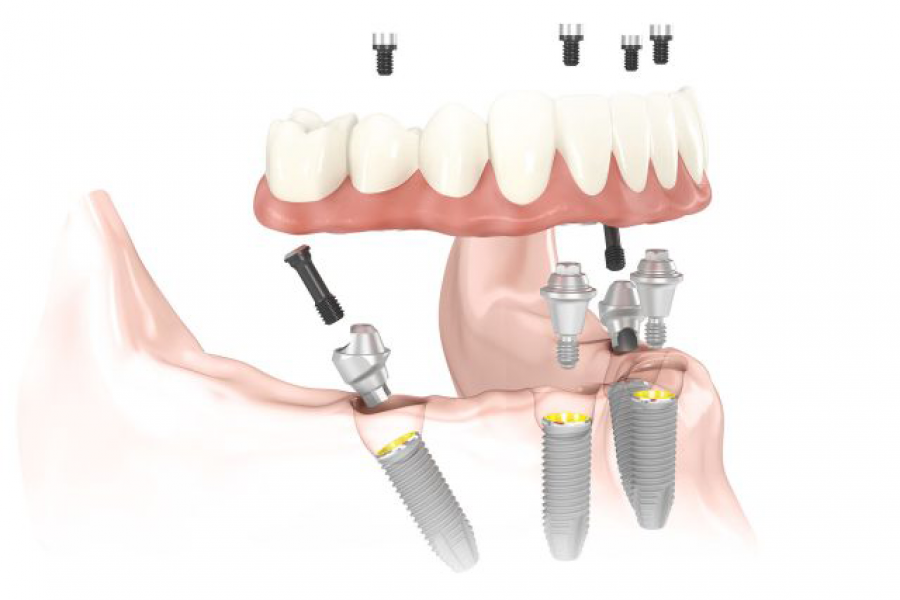 IMPLANTES, LO QUE TODO EL MUNDO DEBERÍA SABER