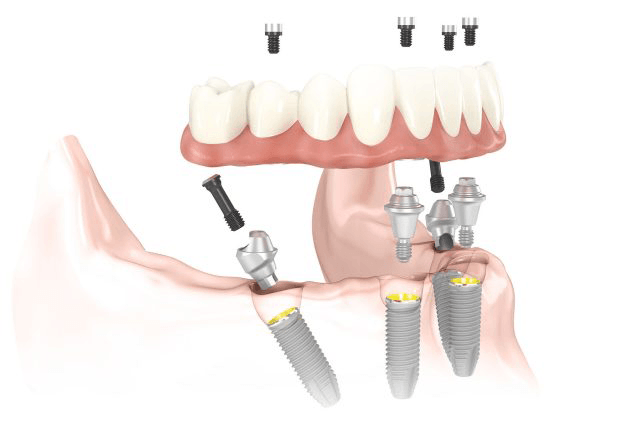 IMPLANTES, LO QUE TODO EL MUNDO DEBERÍA SABER